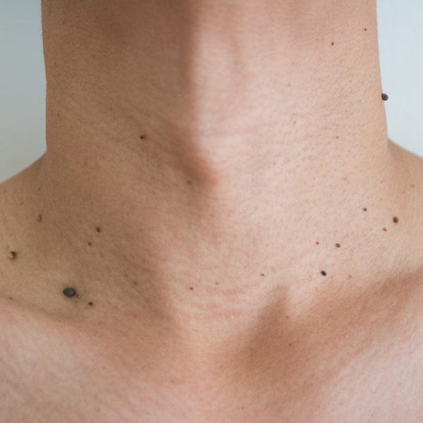 What Causes Skin Tags—and What You Can Do About Them