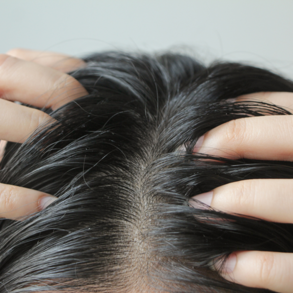 6 Common Causes of Itchy Scalp (and What to Do About Them)