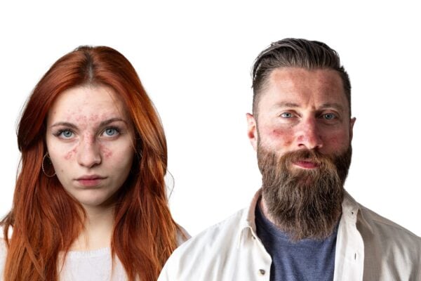 10 Rosacea Myths Busted by Certified Dermatologists