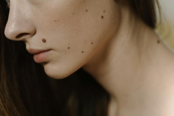 Can Skin Moles be Removed Safely?