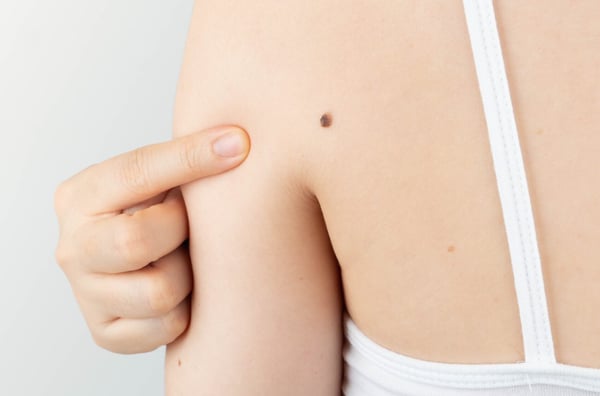 Does This Look Like Cancer? 4 Signs You Should Get Checked by a Dermatologist