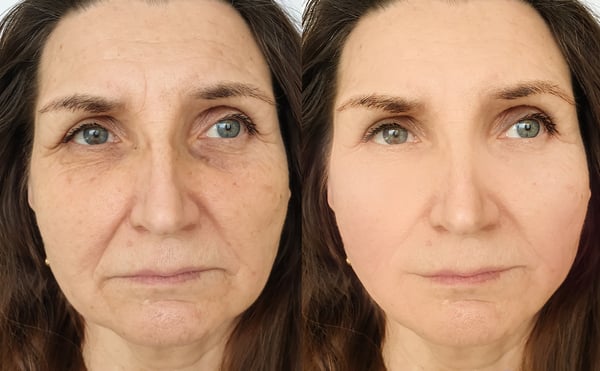 Fixing “Ozempic Face”: Addressing Facial Volume Loss the Healthy Way