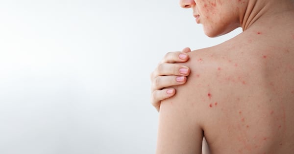 Why Adult Acne is Different—and What Actually Helps