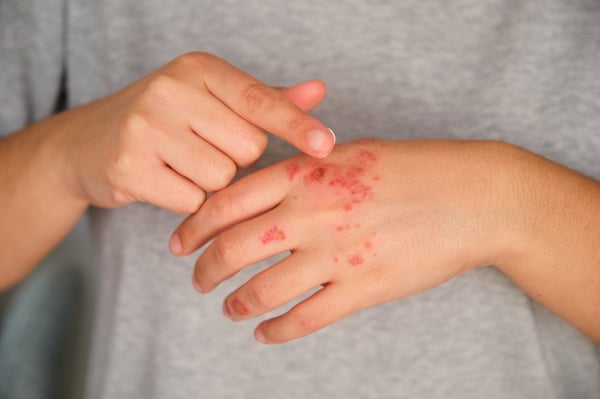 What You Need to Know About Eczema