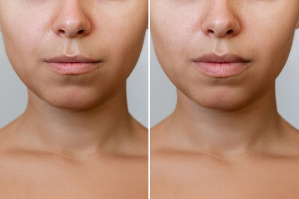 Subtle vs Noticeable: How Dermatologists Plan Treatments That Don’t Change Your Face