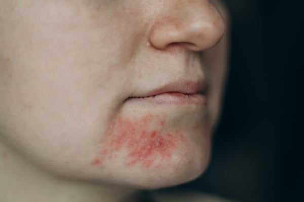 Perioral Dermatitis: When “Acne Around the Mouth” Isn’t Acne