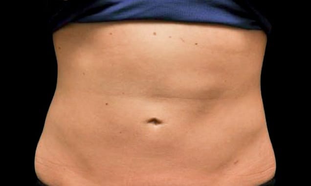 CoolSculpting After