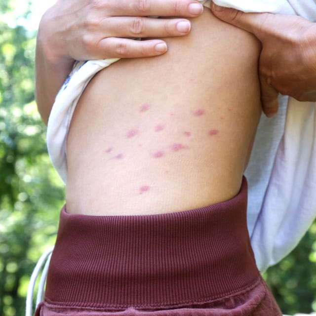 Bed Bugs