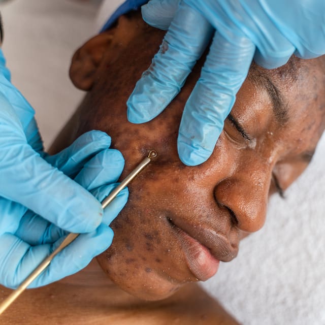 Extractions