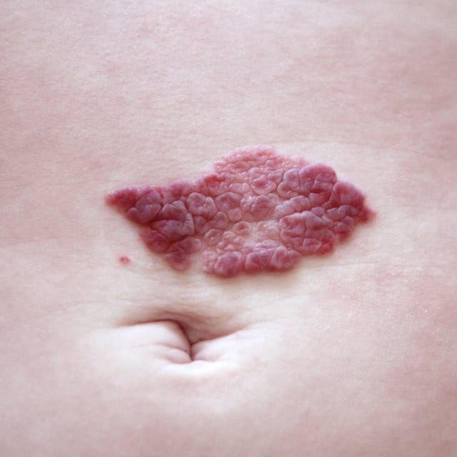 Hemangiomas
