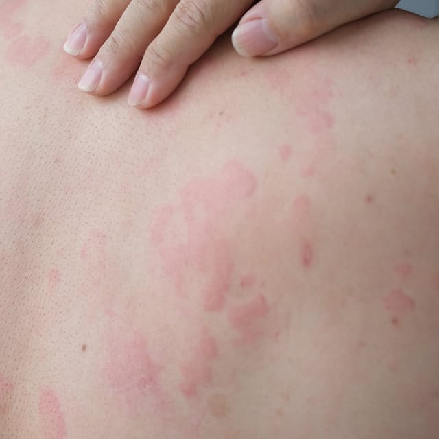 Hives