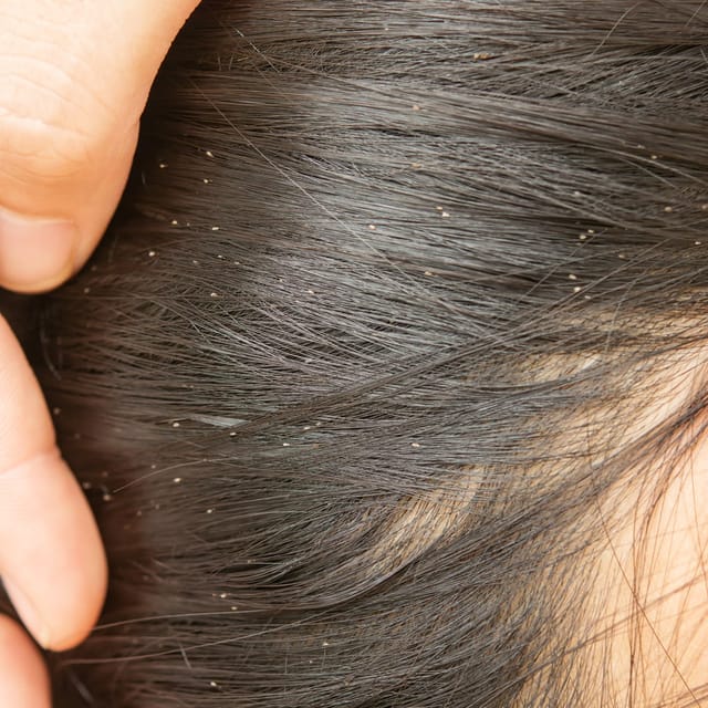 Lice