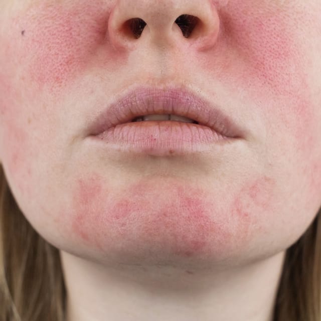 Rosacea