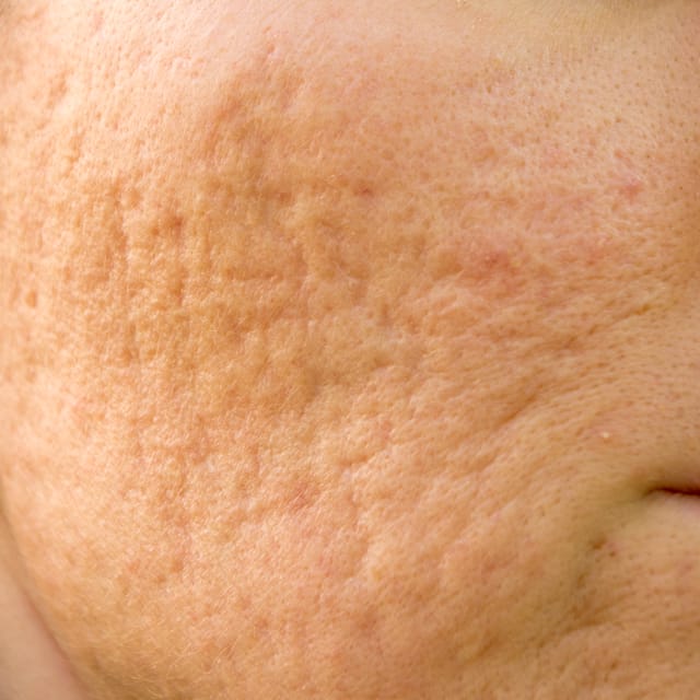 Scar Subcision and Punch Elevation