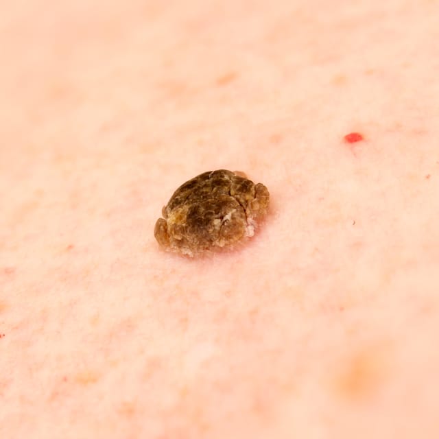 Seborrheic Keratosis