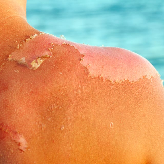 Sun Damage