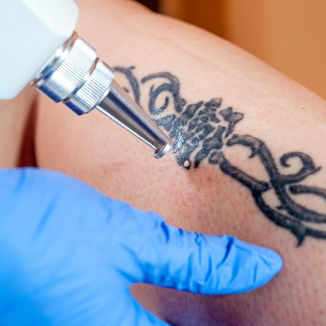 Tattoo Removal