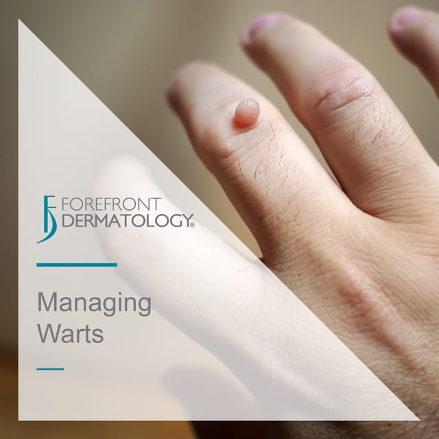 managing warts