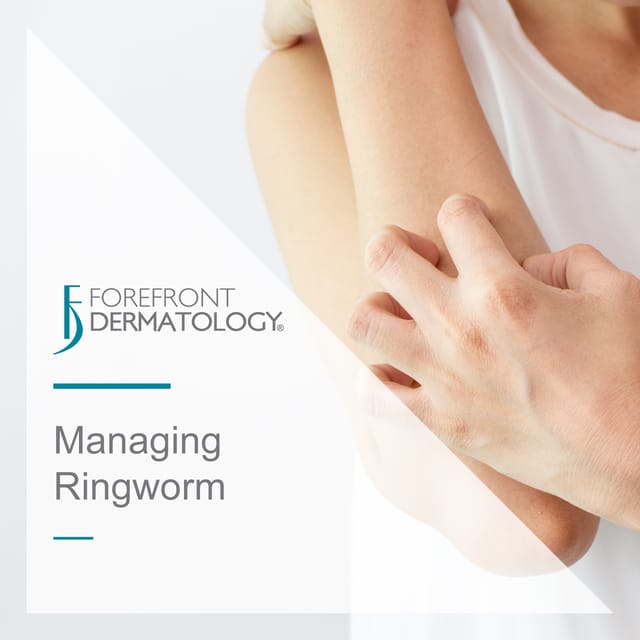 managing ringworm