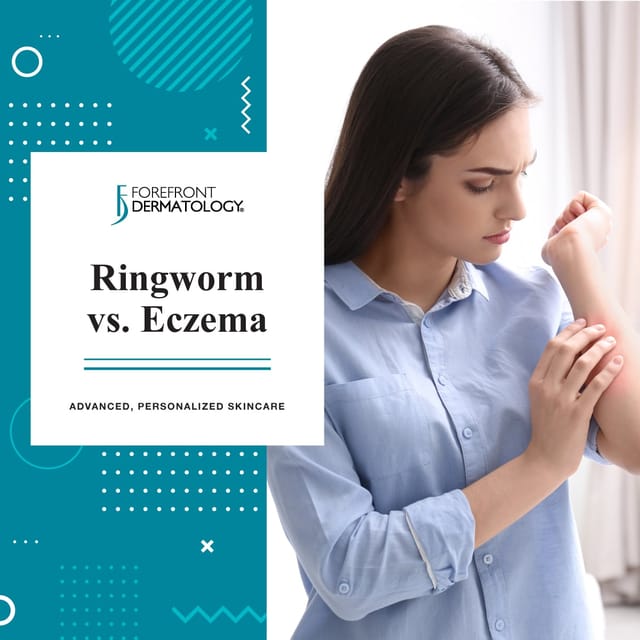 RINGWORM VS ECZEMA