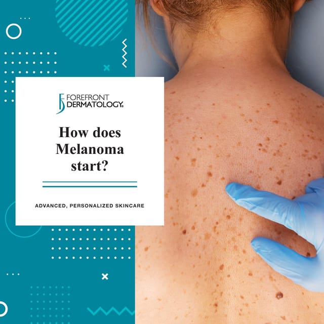 how does melanoma start