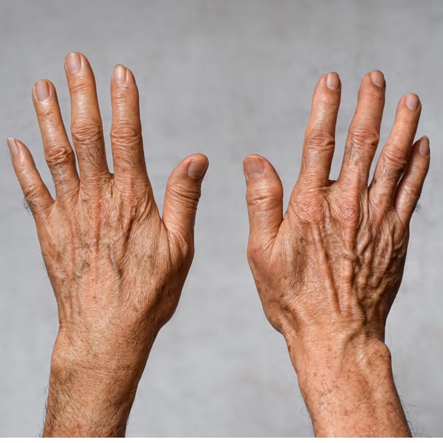 What Causes Brown Spots and How to Remove Them 