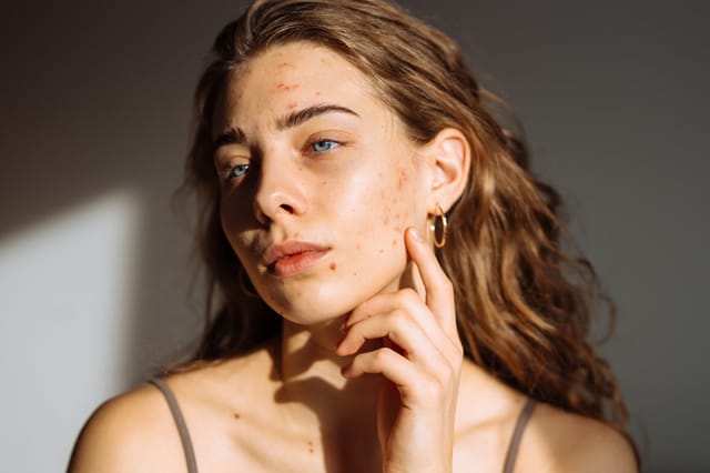 woman inspecting acne scars on face