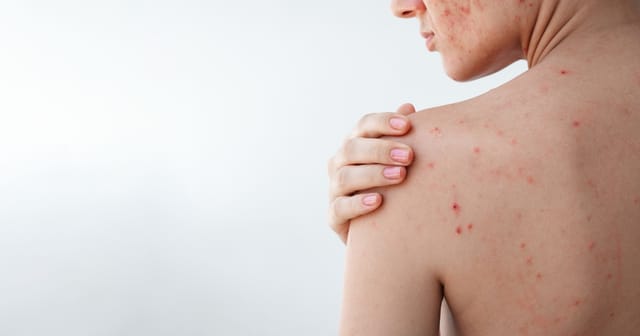 back of young woman with acne on skin and part of face