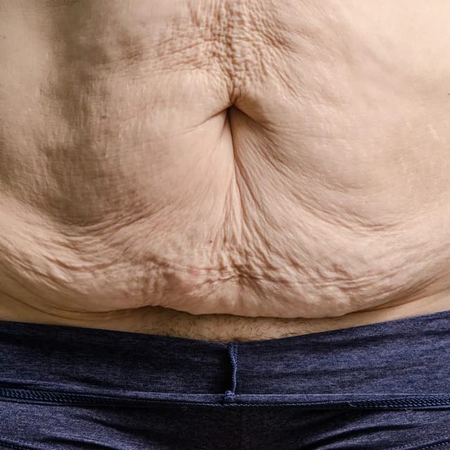 Post weight-loss surgery