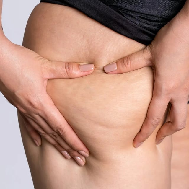 Thigh lift
