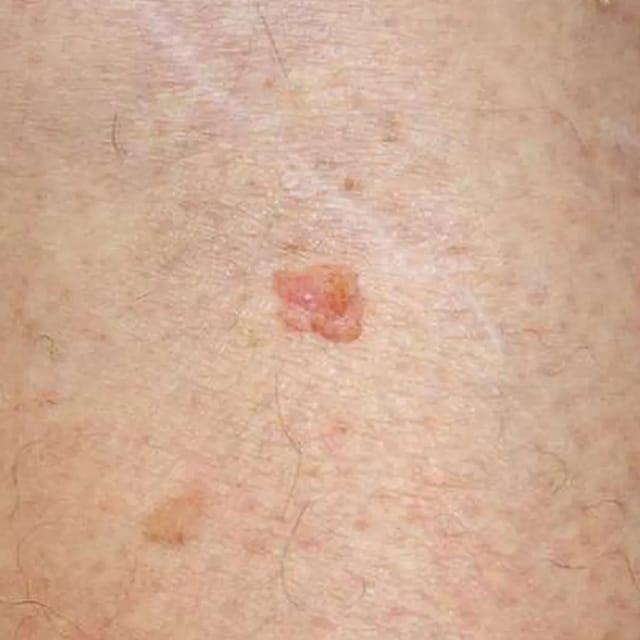 Skin Cancer Treatment