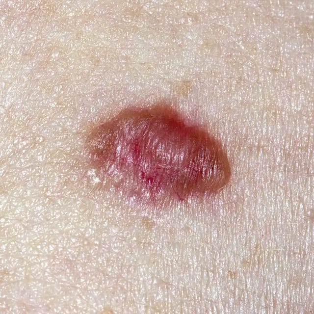 Basal Cell Carcinoma