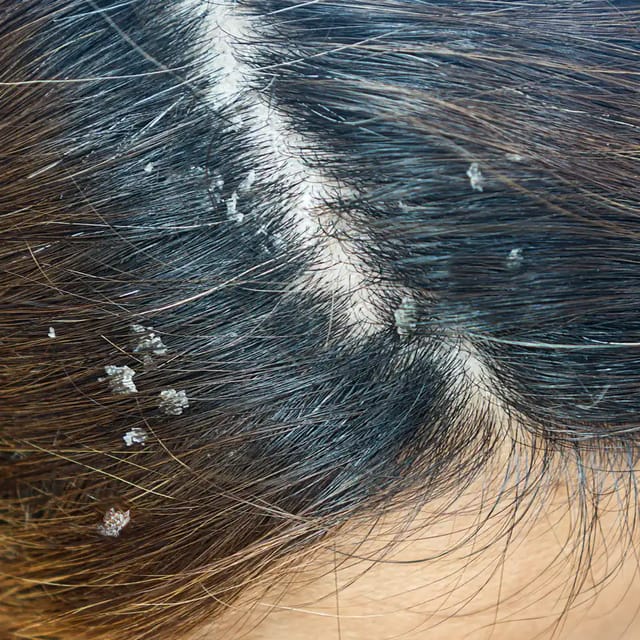 Seborrheic Dermatitis