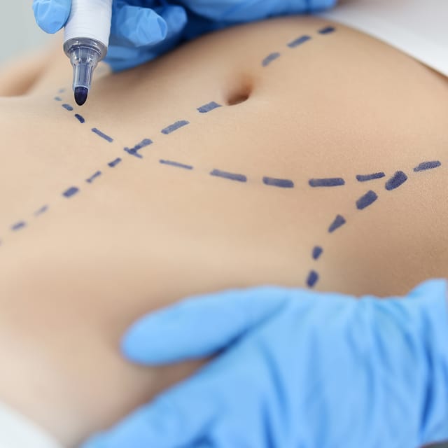 Liposuction vs. Tummy Tuck