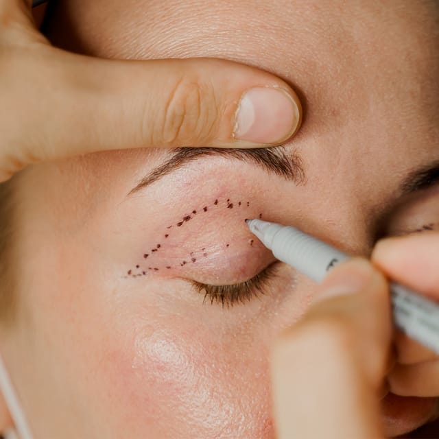Blepharoplasty