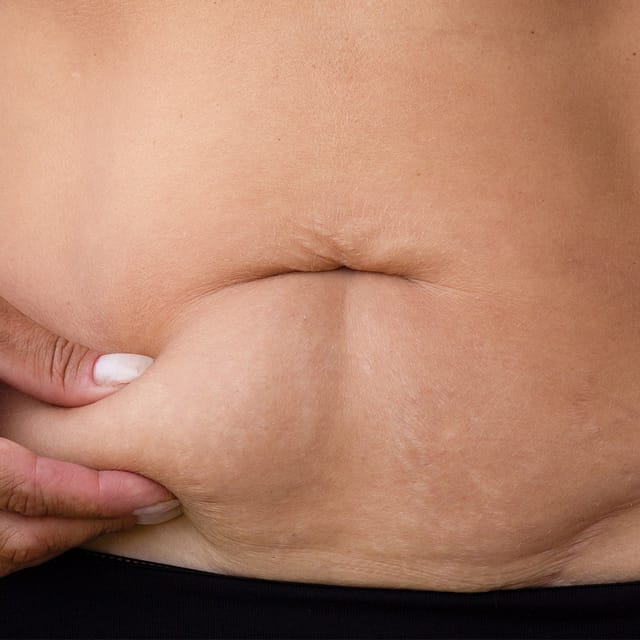 Thermi250® Skin Tightening
