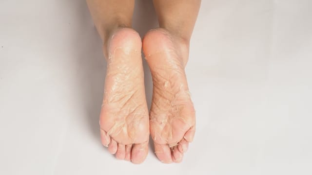The soles of a pair of feet with peeling skin and dry skin needing treatment