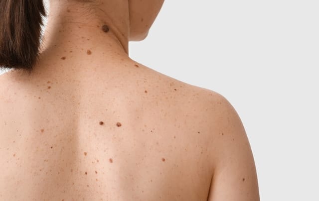 back of woman covered in moles question of skin cancer could use reflectance confocal microscopy