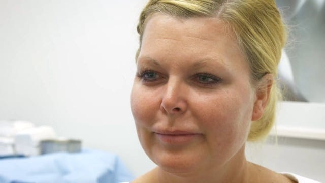 Dr.Kelleher - Neck Liposuction