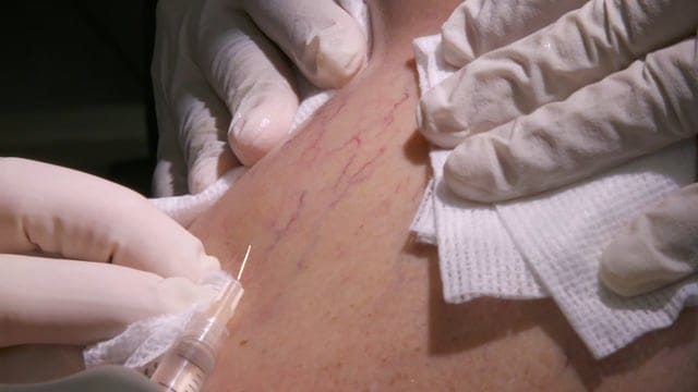 Dr.Kelleher - Sclerotherapy