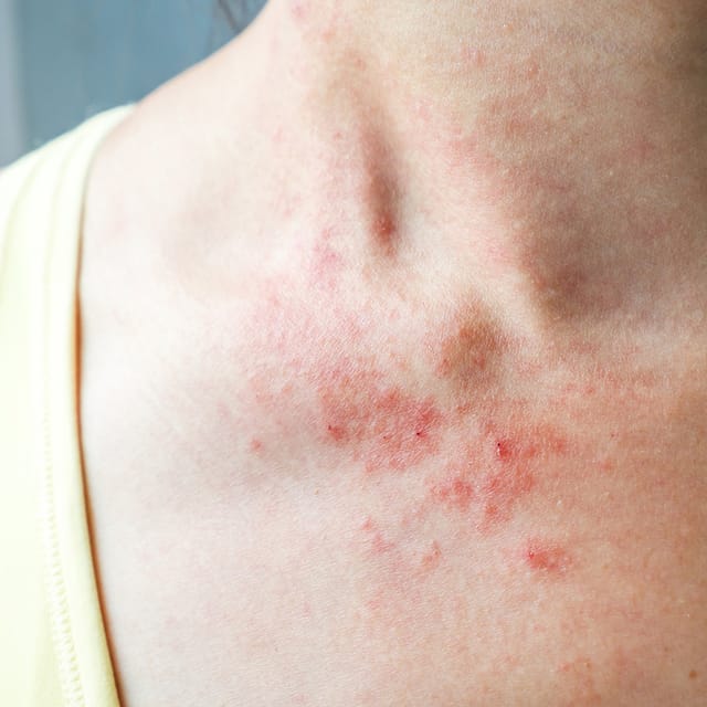 Rashes