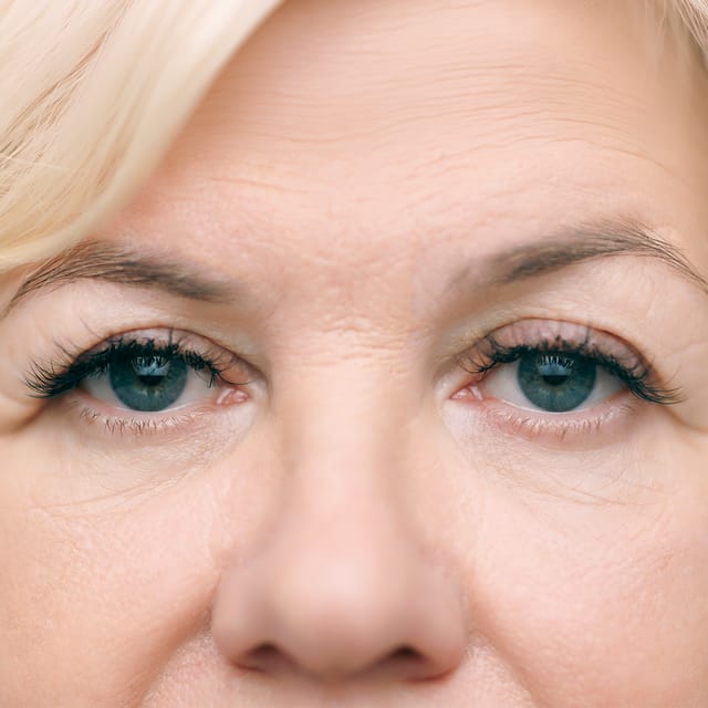Brow Lift