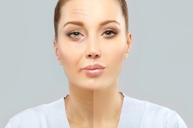 Half and half picture depicting older woman with frown lines and expression lines which are eventually helped with botox dyspost xeomin