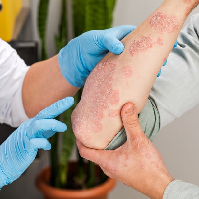 Psoriasis