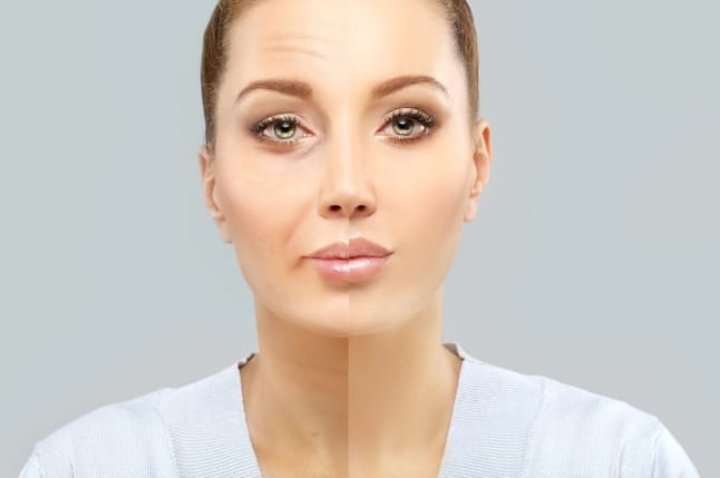 Half and half picture depicting older woman with frown lines and expression lines which are eventually helped with botox dyspost xeomin