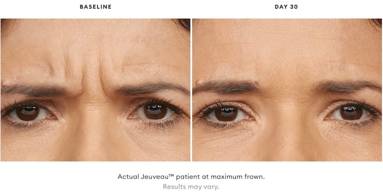 Juveau Before and After