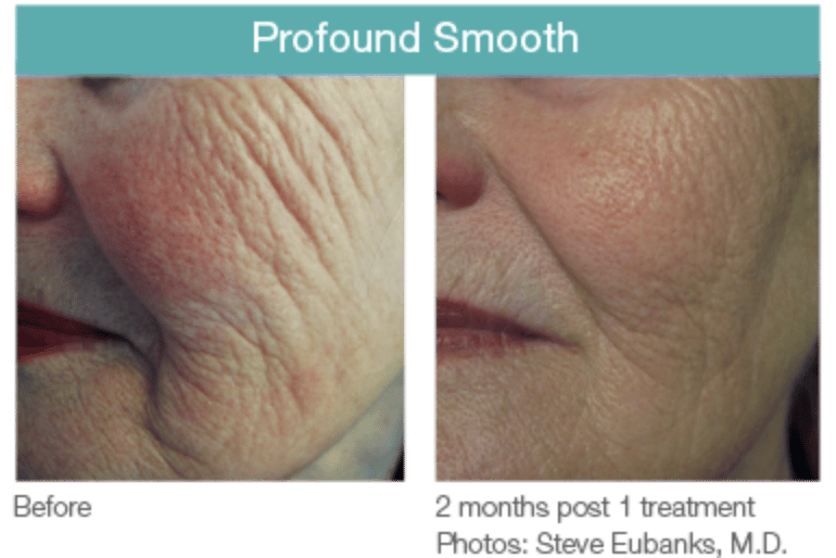 Profound Smooth Before and After