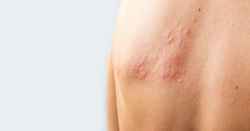 Shingles (Zoster) Condition, Treatments and Pictures for Adults - Skinsight