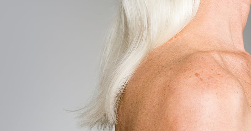 Age Spot Treatment Options: What is Age Spot Treatment? - Forefront  Dermatology