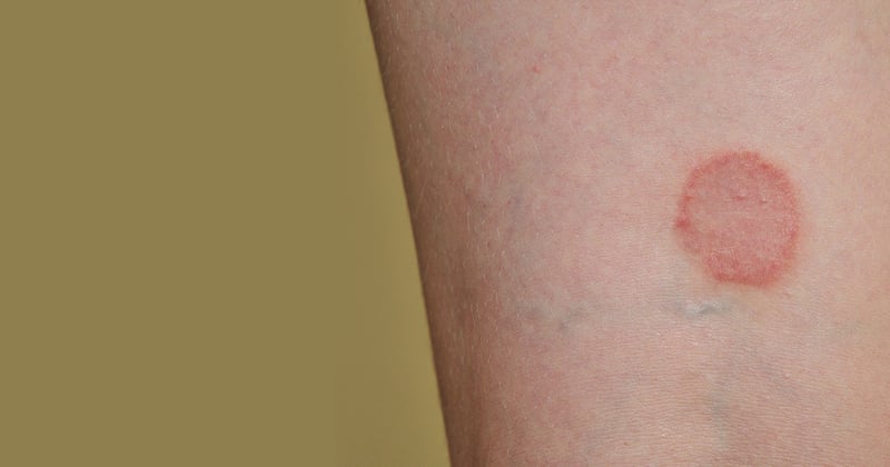ringworm rash on arm